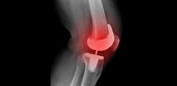 Cos’è la protesi del ginocchio? Quando fare quella totale o quella monocompartimentale (parziale)?